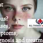 What is lupus and what causes it