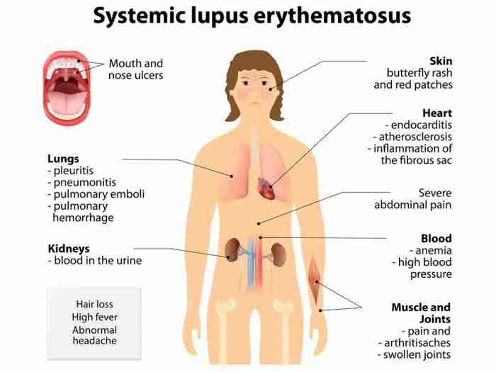 What is Lupus and what causes it?