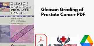 Gleason Grading of Prostate Cancer PDF