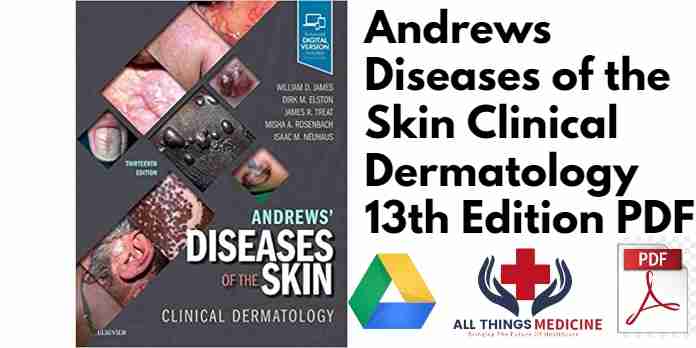 Andrews Diseases of the Skin Clinical Dermatology 13th Edition PDF