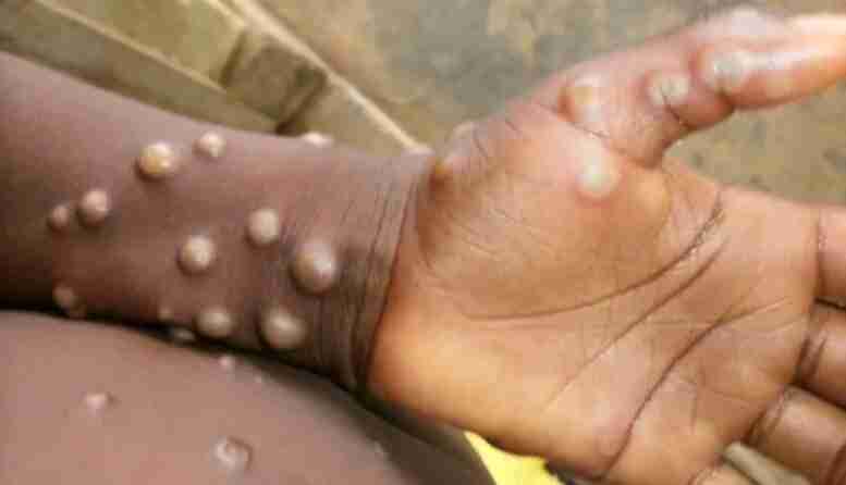 Monkeypox rash picture