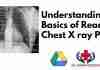 Understanding Basics of Reading Chest X ray PDF