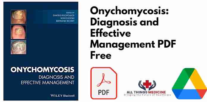 Onychomycosis: Diagnosis and Effective Management PDF