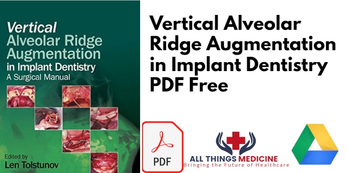 Vertical Alveolar Ridge Augmentation PDF
