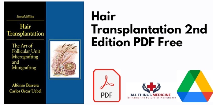Hair Transplantation 2nd Edition PDF