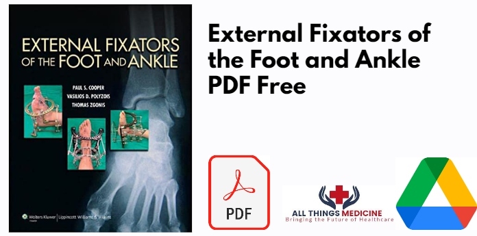 External Fixators of the Foot and Ankle PDF