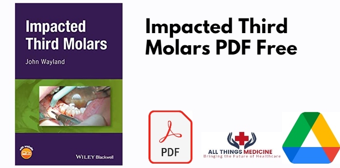 Impacted Third Molars PDF